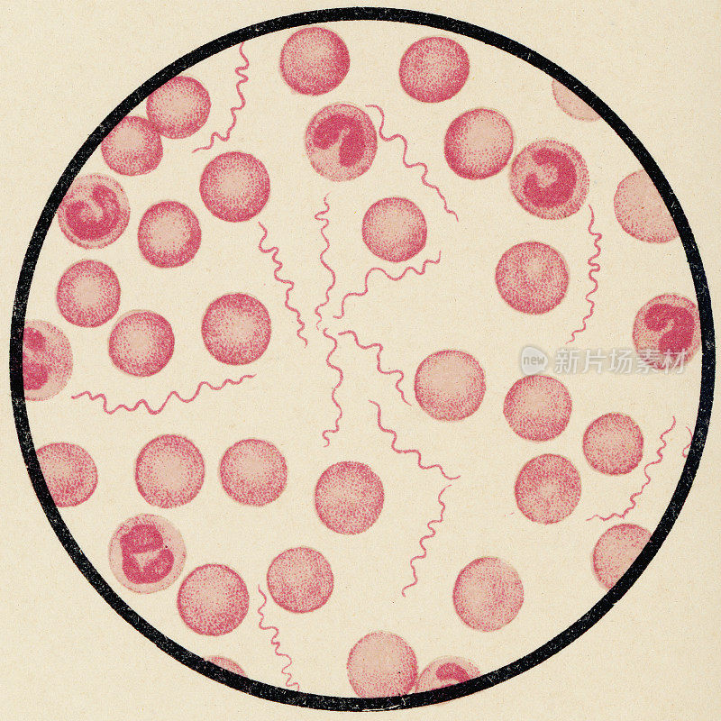 显微镜观察的人血液细胞与螺旋体从一个病人的数独- 19世纪